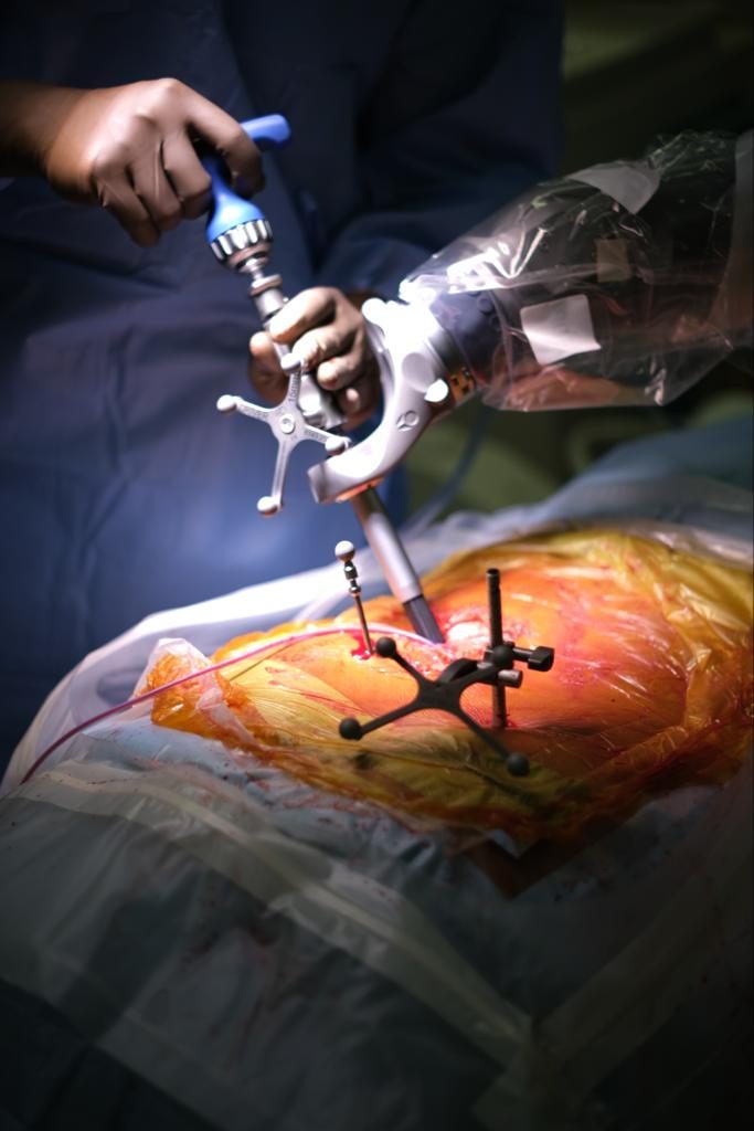 Robotic-assisted spine surgery supported by Mapson